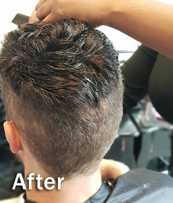Mens Hair Replacement - After