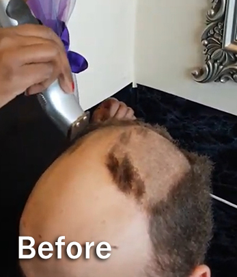 Mens Hair Replacement - Before