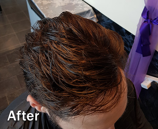 Mens Hair Replacement - After