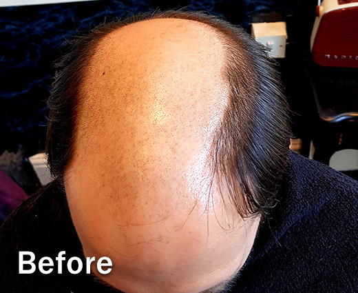 Mens Hair Replacement - Before