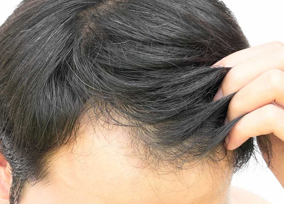 Non Surgical Hair Treatment FAQ