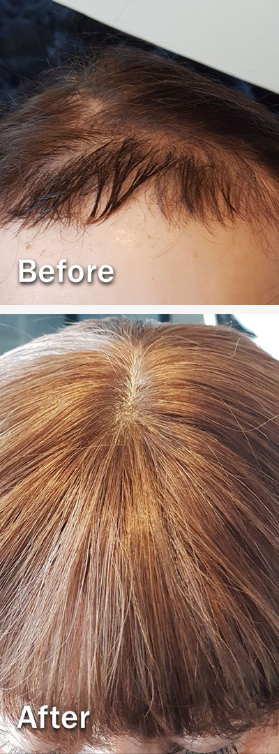 Womens bespoke hair system, before and after