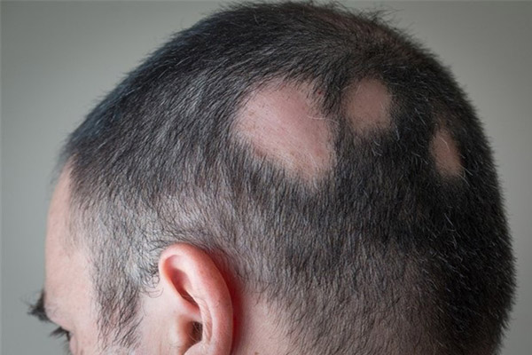 Hair Loss Causes & Treatment